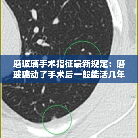 磨玻璃手术指征最新规定：磨玻璃动了手术后一般能活几年? 