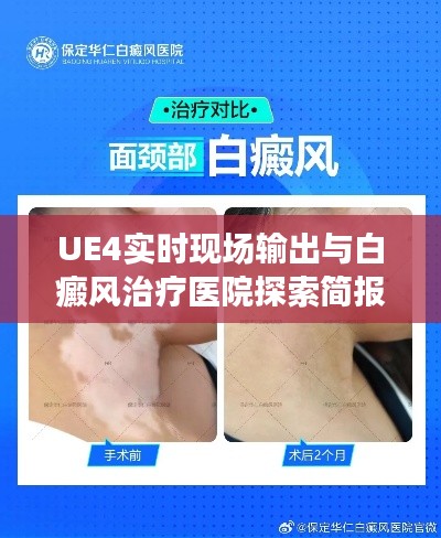 UE4实时现场输出与白癜风治疗医院探索简报
